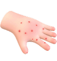 Allergens 5